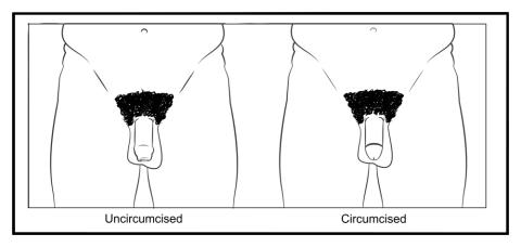 Circumcision